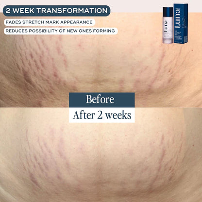 The Skin Support Oil - For Stretch Marks, Hyperpigmentation & Uneven Skin Texture