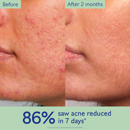 Vinopure Acne-Prone Skin Essentials